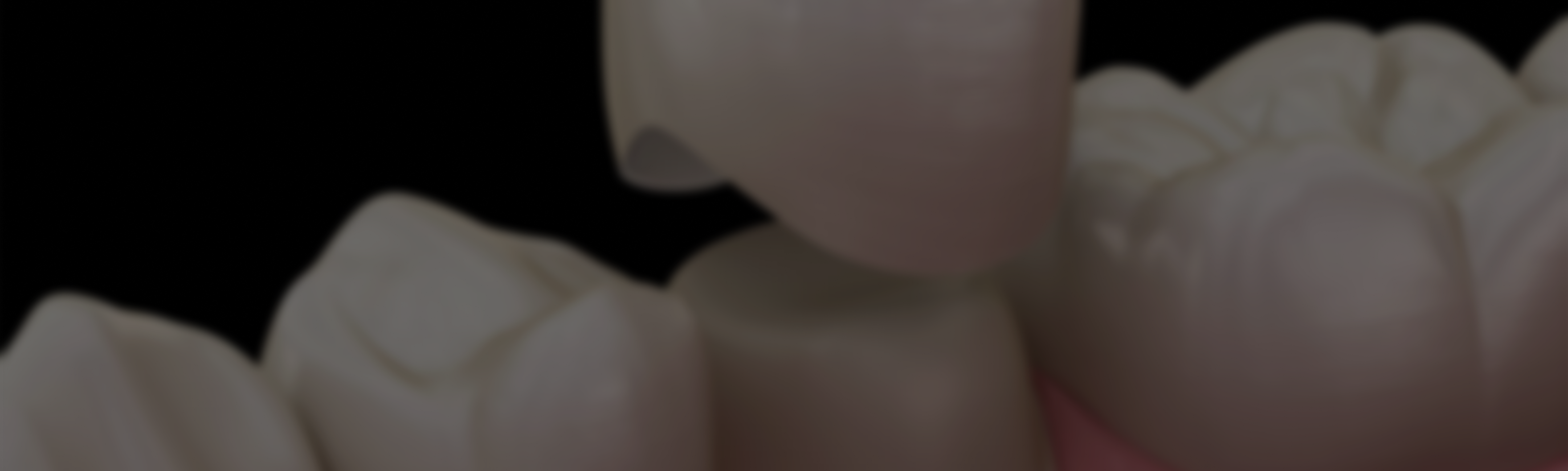 Dental Crowns
