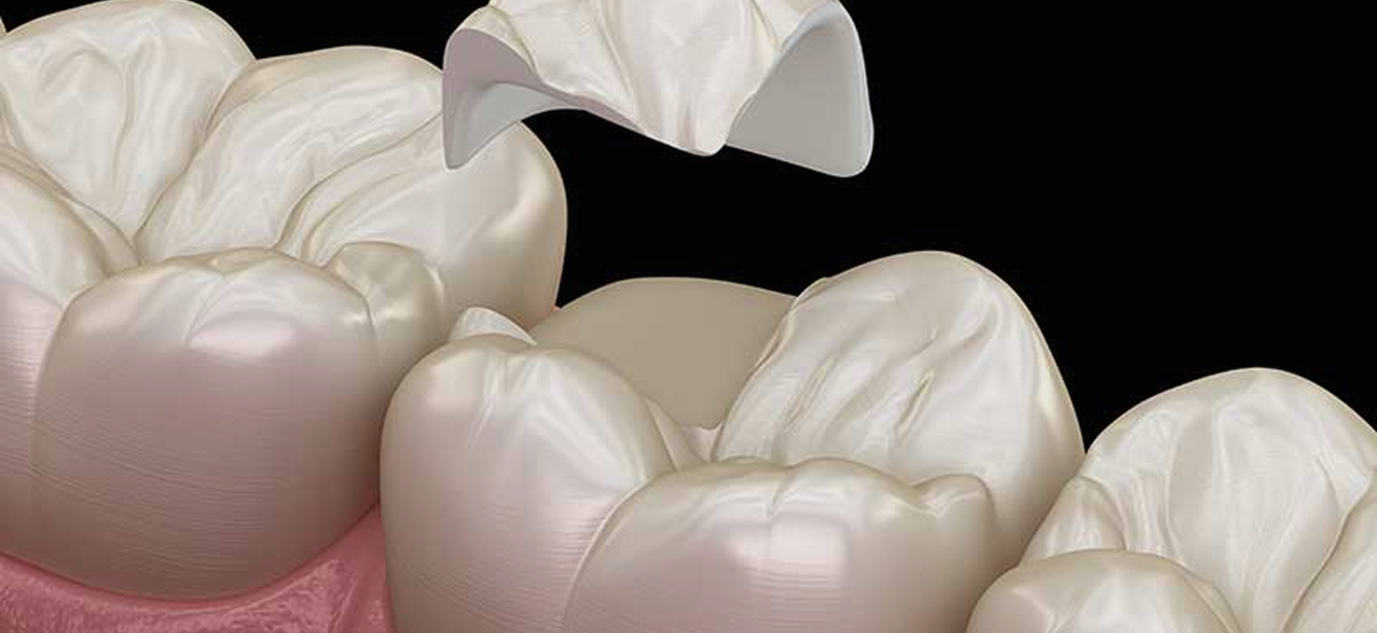 Veneers