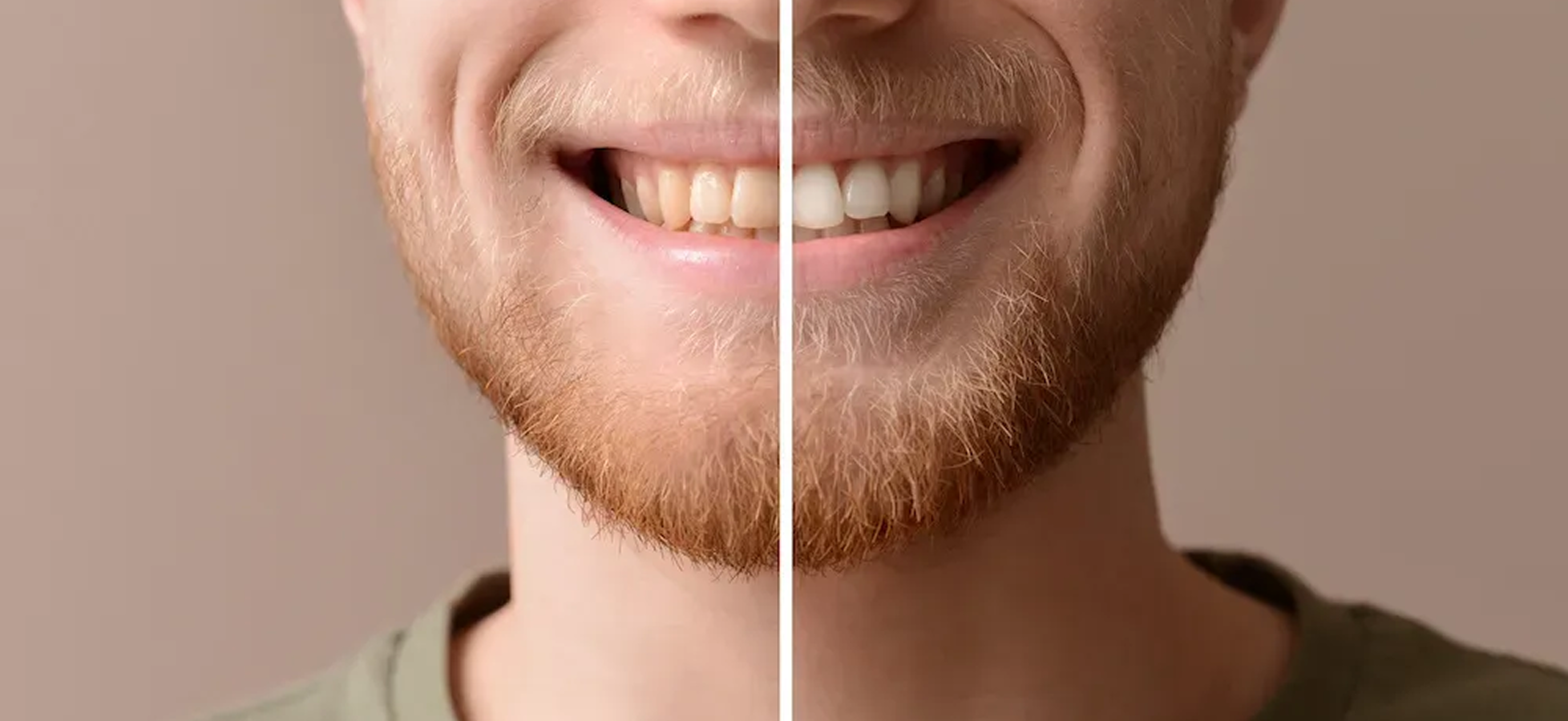 Smile Makeovers