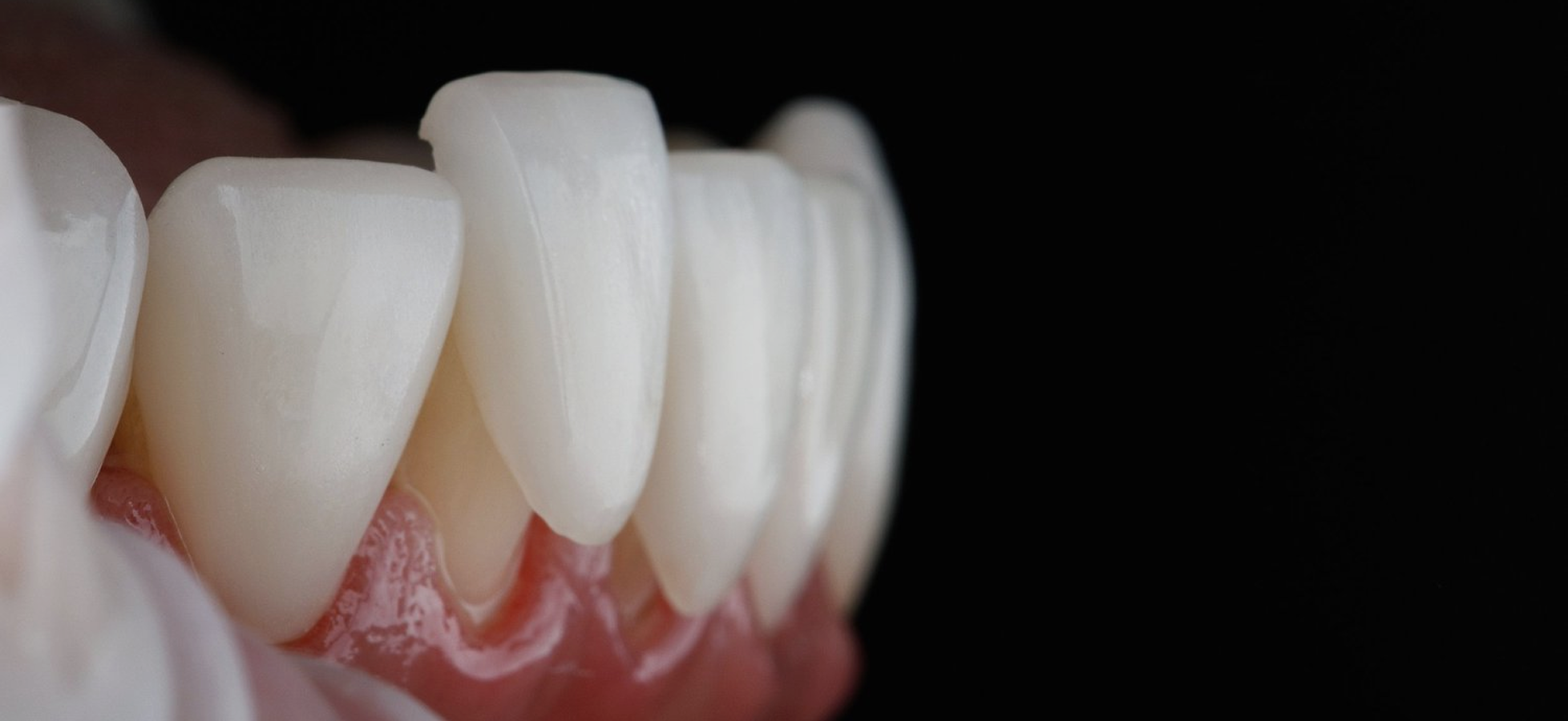 Veneers